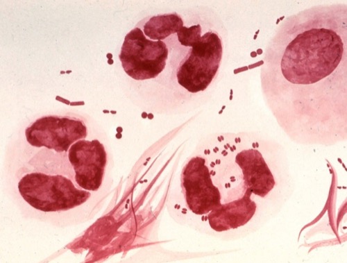 microscopy of urethral discharge due to Gonorrhea (urethritis)