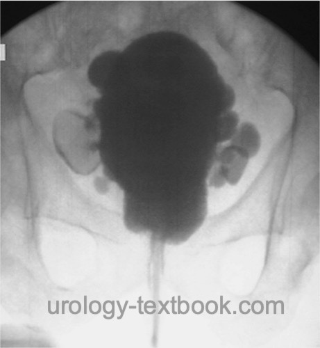 cystography of bladder stones with diverticula due to benign prostate hyperplasia