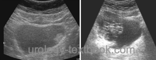 figure Ultrasound imaging of bladder cancer