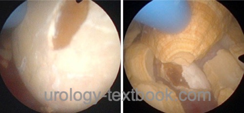 fig. Electrohydraulic lithotripsy of bladder stones