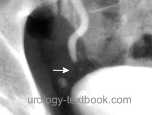 figure Intravenous urography: filling defect in the distal ureter