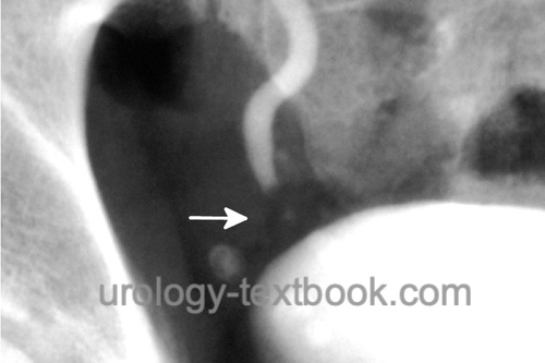 figure Intravenous urography: filling defect in the distal ureter