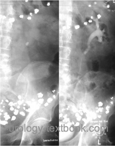 figure Intravenous urography: left ureteral stone with grade II hydronephrosis.