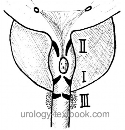 figure Classification of the posterior urethral valves after Young (1919)