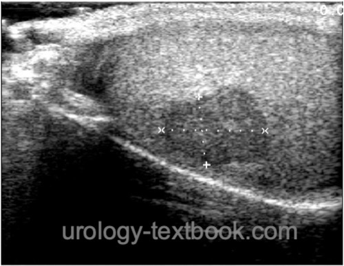 figure Testicular ultrasound imaging of germ cell tumors