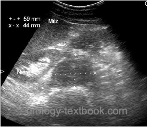 figure Abdominal ultrasound imaging: large paraaortic lymph node metastasis of testicular cancer below the left kidney.