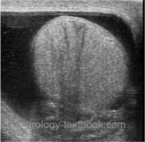 figure ultrasound imaging: Hydrocele of the testis