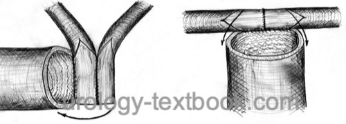 figure ileal conduit: Different options of the uretero-ileal anastomosis using the Wallace technique.