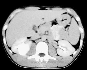 ct examination of a calyceal cyst