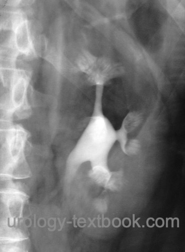 fig. urography of medullary sponge kidney with ectatic collecting ducts