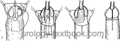 figure Mathieu hypospadias repair step by step