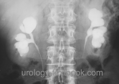 megacalycosis as seen in intravenous urography