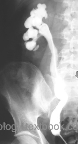 fig. retrograde pyelography of primary obstructive megaureter