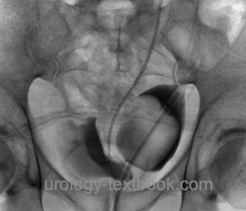 figure Cystography of a bladder diverticulum prior to surgical therapy: a catheter was inserted into the diverticulum and blocked with 50 ml. A DJ was inserted to mark the orifice and ureter. The ureter and bladder are displaced to the right by the left diverticulum.
