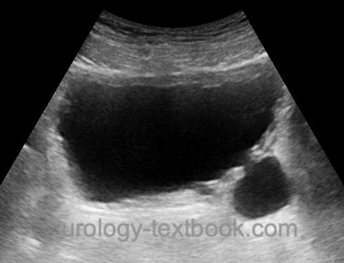 figure Ultrasound imaging of a small bladder diverticulum