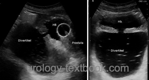 figure Ultrasound imaging of a large diverticulum caused by BPH (sagittal plane (left) and transverse plane (right)