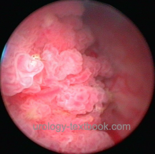 Bladder cancer as seen in cystoscopy