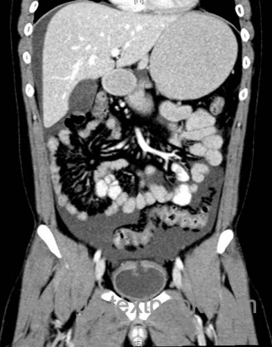 fig. CT of an intraperitoneal bladder rupture injury