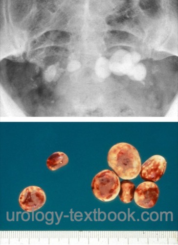 figure Abdominal radiograph with bladder calculi