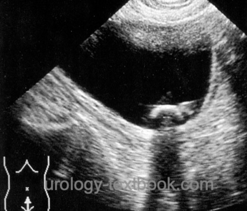 fig. ultrasonography of a urinary bladder stone