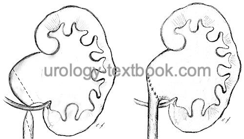 figure schema of a ureteropelvic obstruction causes by a lower pole renal vessel