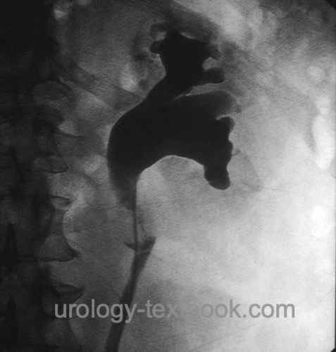 figure Retrograde pyelography: ureteral stricture due to upper tract urothelial carcinoma