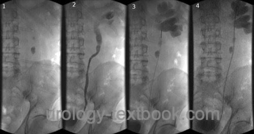 figure Placement of a DJ ureteral splint