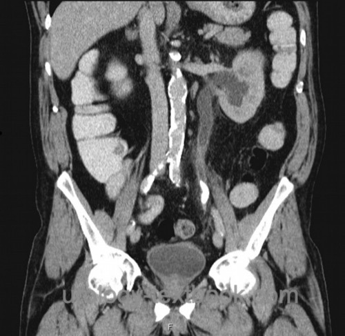 figure Noncontrast CT (frontal reconstruction) with large left-sided ureteral stone