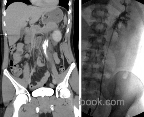 figure Left-sided ureteral injury: abdominal CT (excretion phase) and retrograde pyelography after fall from great height