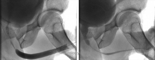 fig. Retrograde urethrography (left) and voiding cystourethrography (right) of a short bulbar urethral stricture