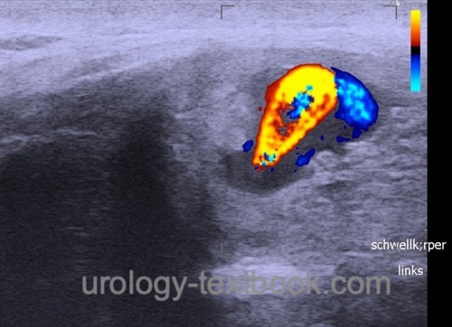 fig. Doppler ultrasound imaging of high-flow priapism after perineal trauma