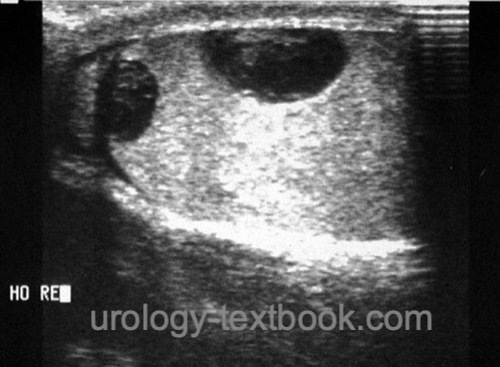 fig. ultrasonography of a testicular hematoma after blunt testicular trauma