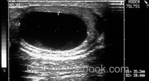figure testicular ultrasound of a Simple testicular cyst