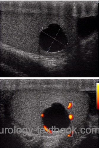 figure testicular ultrasound of a simple testicular cyst with Doppler