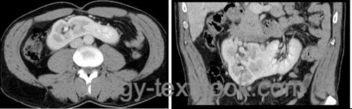 fig. computed tomography of a horseshoe kidney