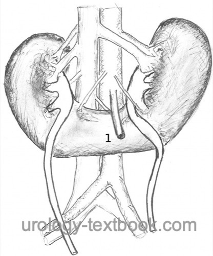 fig. Schematic drawing of a horseshoe kidney