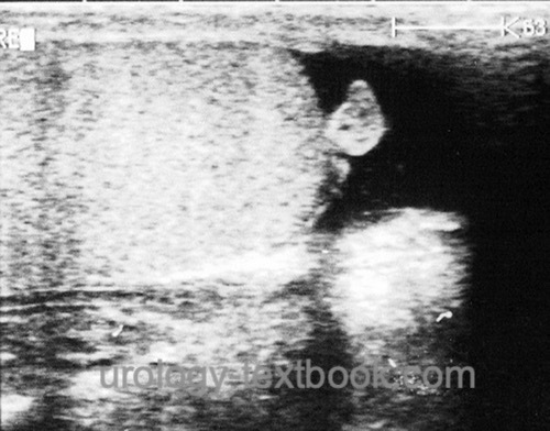 fig. ultrasonography torsion of testicular appendage