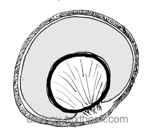 schematic drawing of a simple hydrocele