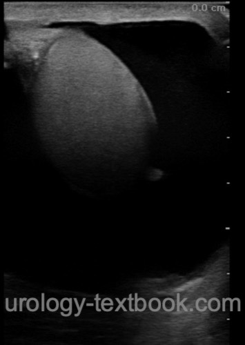 figure ultrasound imaging: Hydrocele of the testis