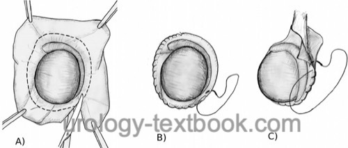 figure Hydrocelectomy with resection of the hydrocele sac.