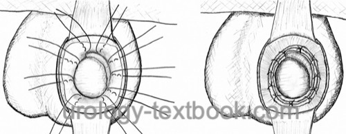 fig. Lord technique of hydrocele surgery (hydrocelectomy)