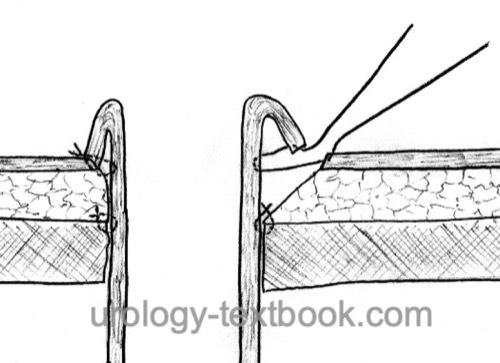 figure ileal conduit: skin sutures for a nipple stoma.