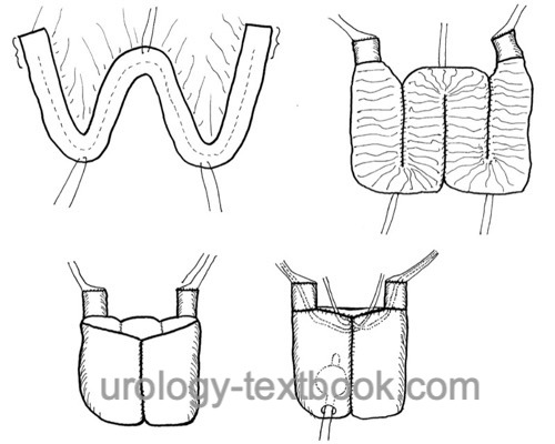 figure ileum neobladder (Hautmann technique)