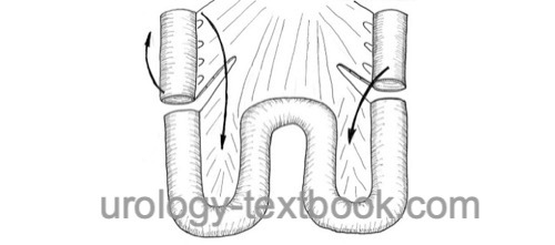 figure ileal pouch bowel dissection