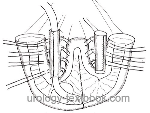 figure ileal pouch Two serosal-lined ileal troughs are used as continence mechanism and antireflux mechanism.