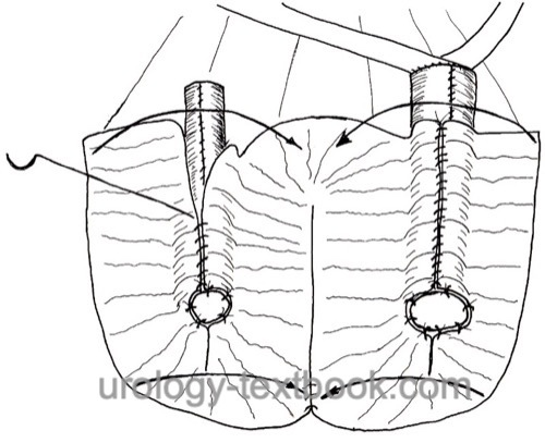 figure ileal pouch The pouch plate is folded in the longitudinal axis and closed with a running suture