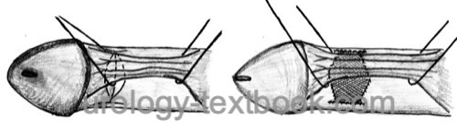 figure: Correction of penile curvature using incision and grafting