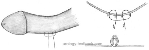 figure: Correction of penile curvature using the plication procedure with buried knots.