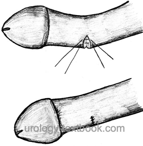 figure: Correction of penile curvature using the Nesbit procedure