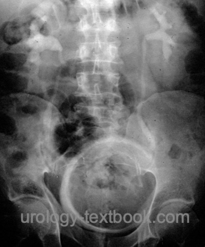 fig. Intravenous urography of bladder tamponde: large round filling defect in the bladder